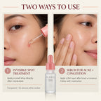 The Acne Concentrate